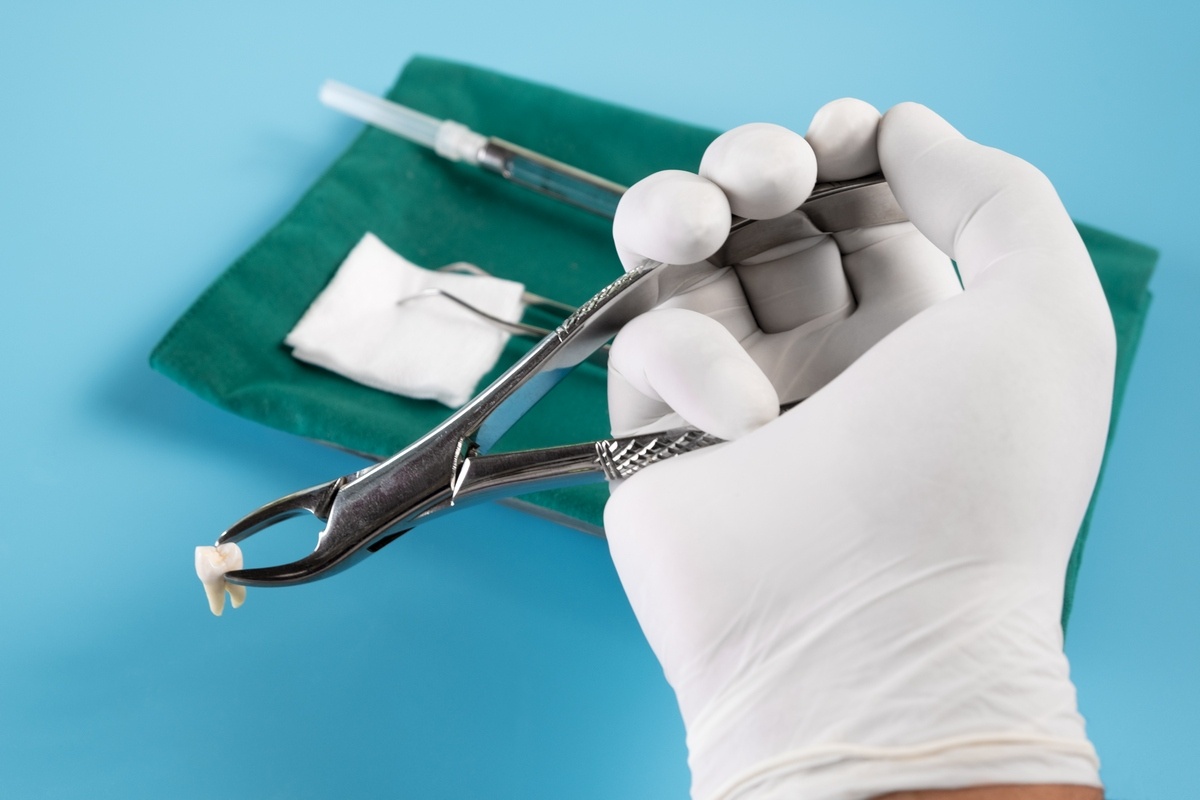 oralnakirurgija-odstranitev_zoba_drcuratis